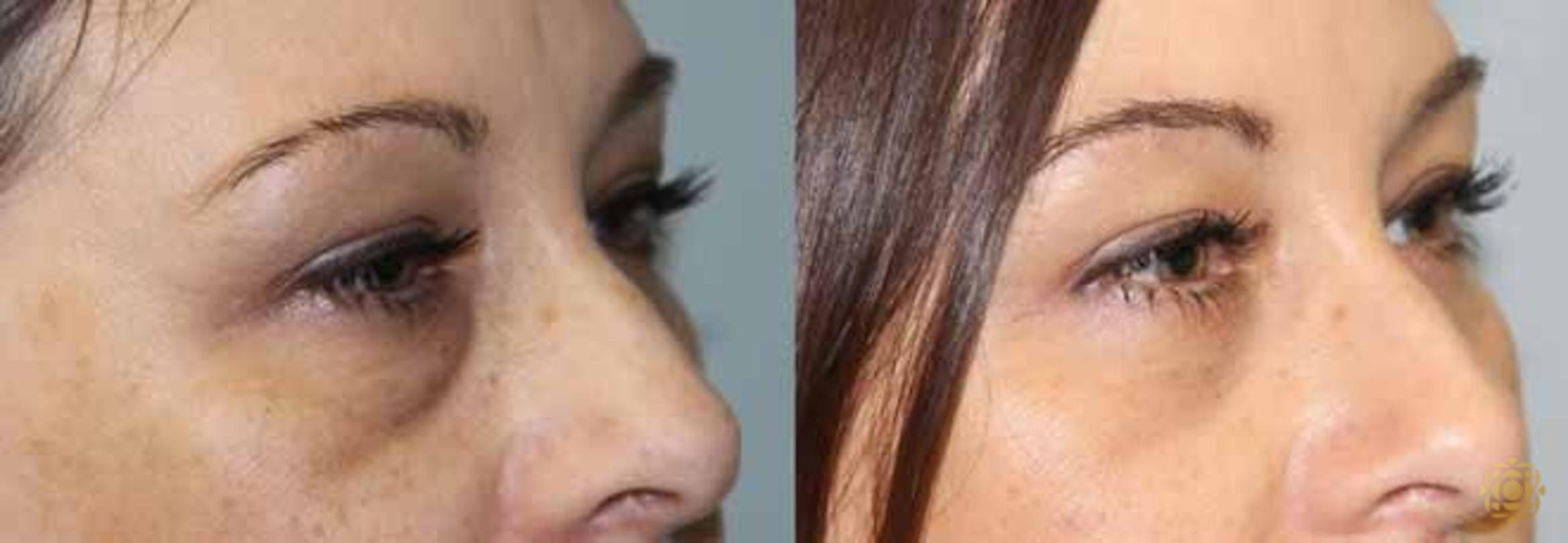 Before & After Blepharoplasty Case 207 View #3 View in Newport Beach, CA