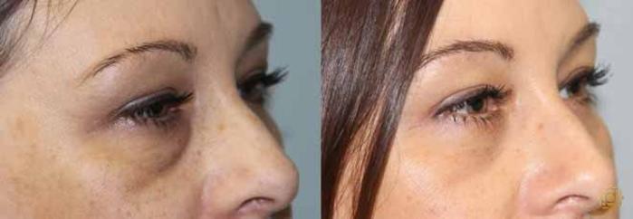 Before & After Blepharoplasty Case 207 View #3 View in Newport Beach, CA