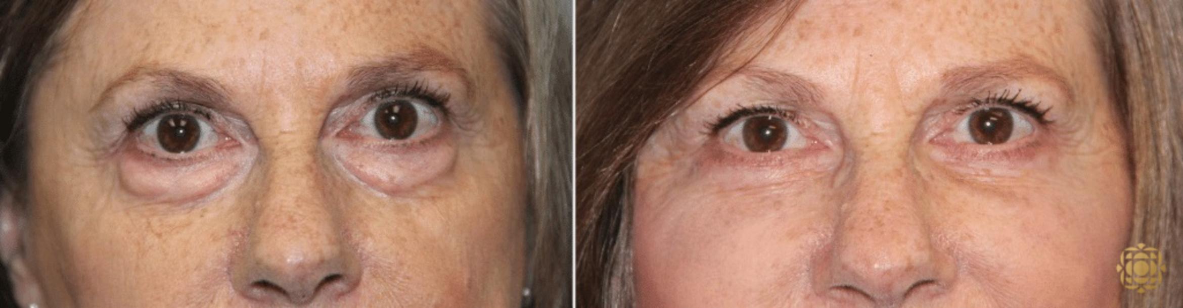 Before & After Blepharoplasty Case 208 View #1 View in Newport Beach, CA