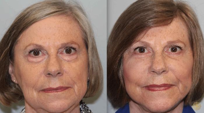 Before & After Blepharoplasty Case 208 View #2 View in Newport Beach, CA