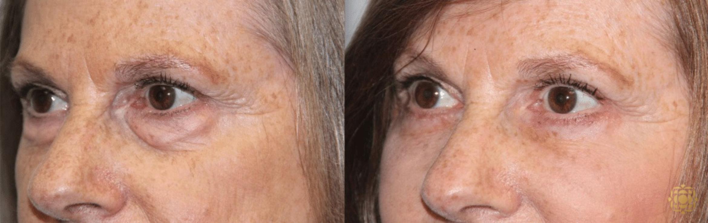 Before & After Blepharoplasty Case 208 View #3 View in Newport Beach, CA