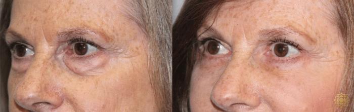 Before & After Blepharoplasty Case 208 View #3 View in Newport Beach, CA