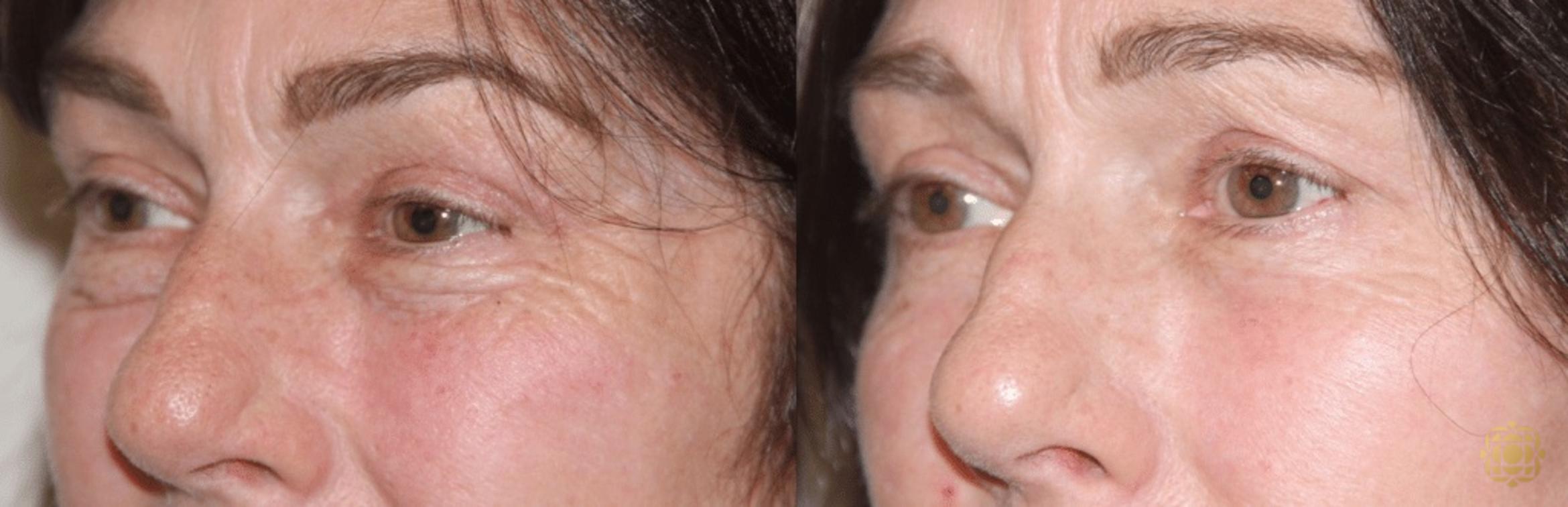 Before & After Blepharoplasty Case 209 View #1 View in Newport Beach, CA
