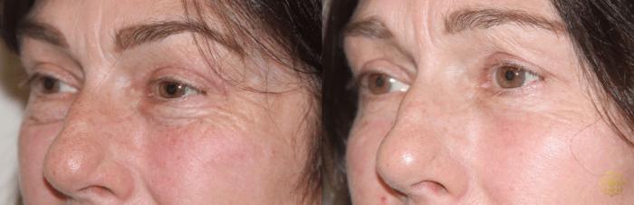 Before & After Blepharoplasty Case 209 View #1 View in Newport Beach, CA