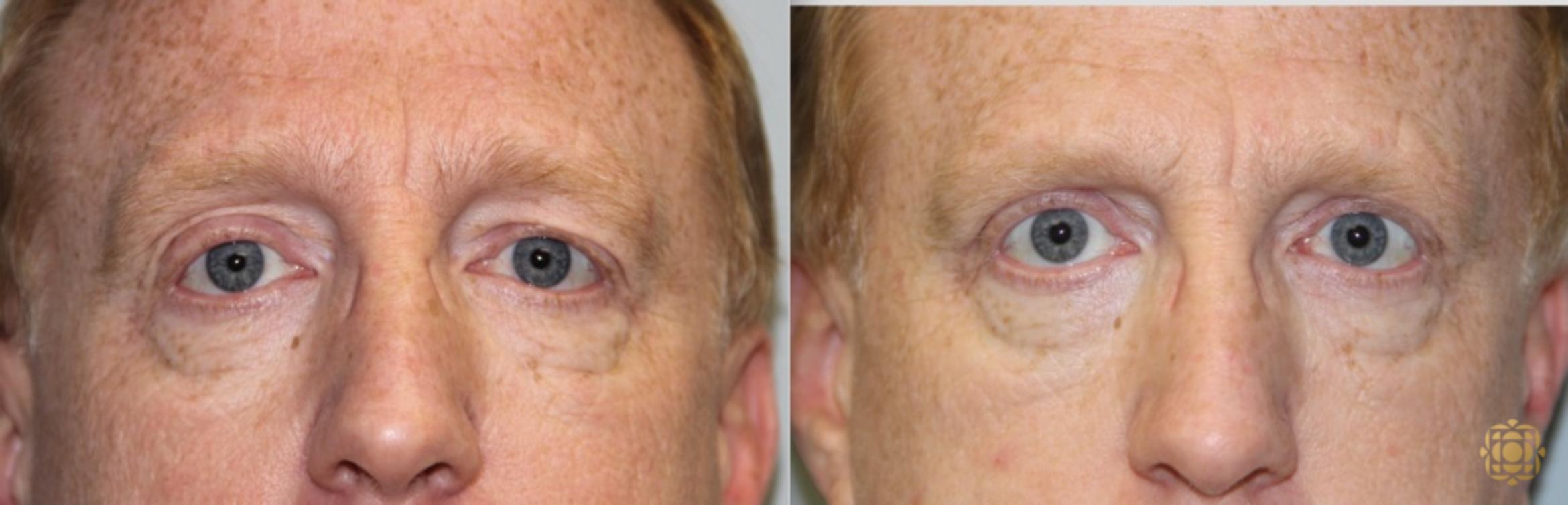 Before & After Blepharoplasty Case 214 View #1 View in Newport Beach, CA