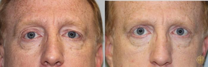 Before & After Blepharoplasty Case 214 View #1 View in Newport Beach, CA