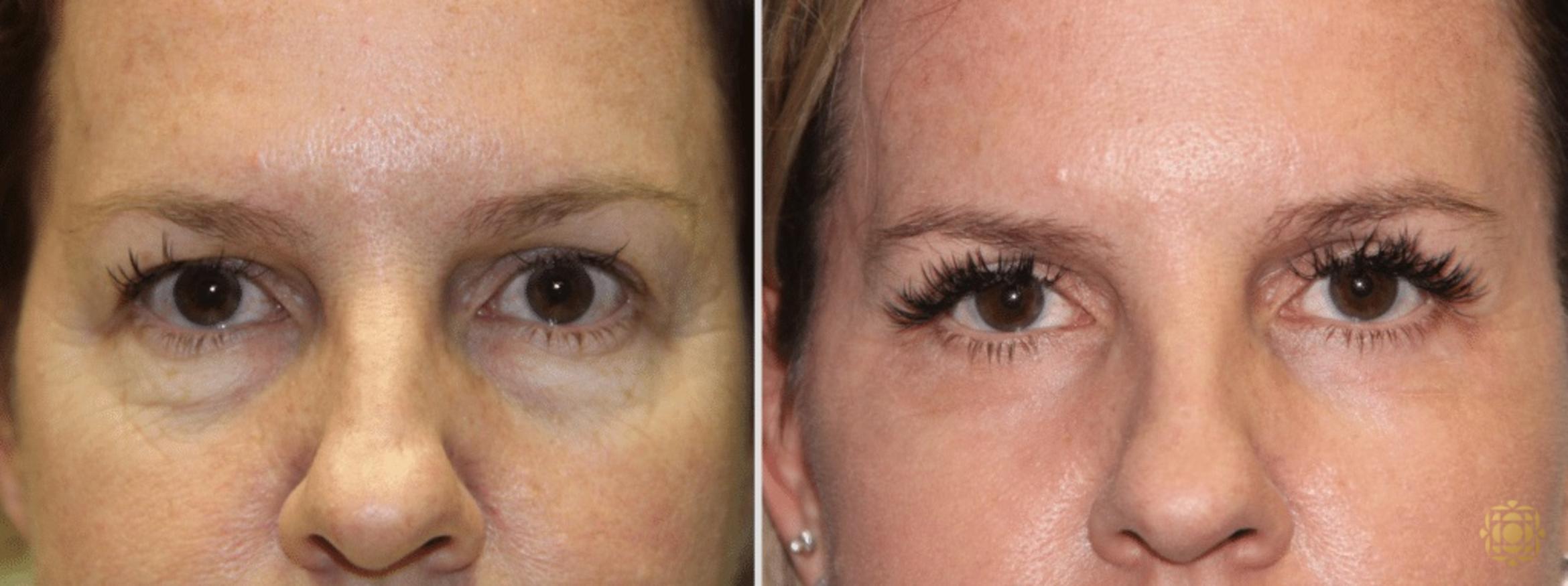 Before & After Blepharoplasty Case 215 View #1 View in Newport Beach, CA