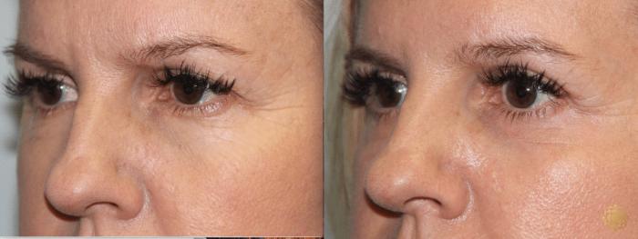 Before & After Blepharoplasty Case 215 View #2 View in Newport Beach, CA
