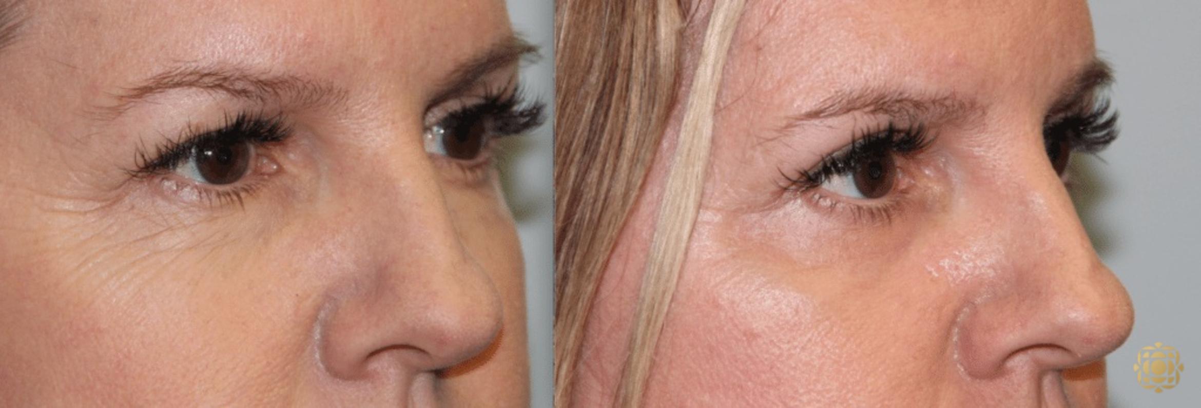 Before & After Blepharoplasty Case 215 View #3 View in Newport Beach, CA