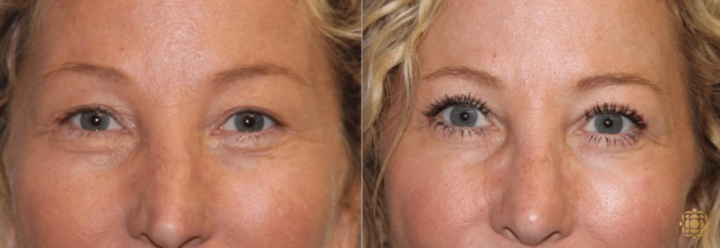Before & After Blepharoplasty Case 216 View #1 View in Newport Beach, CA