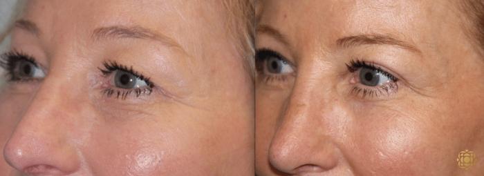 Before & After Blepharoplasty Case 216 View #2 View in Newport Beach, CA