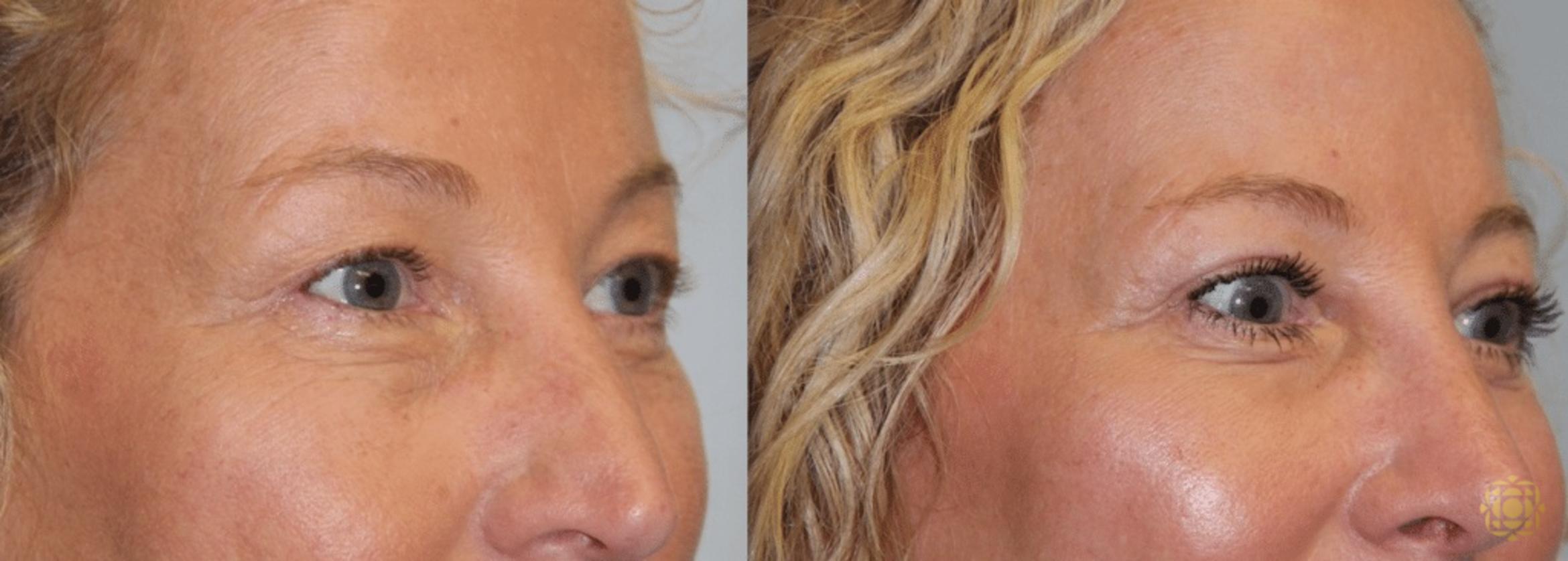 Before & After Blepharoplasty Case 216 View #3 View in Newport Beach, CA