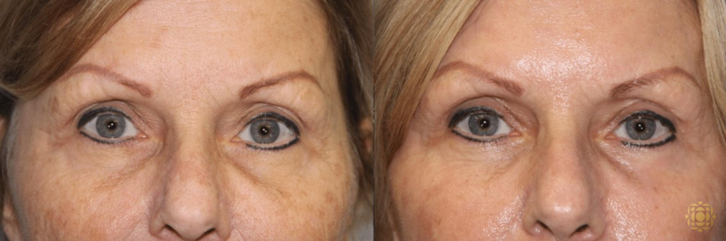 Before & After Blepharoplasty Case 217 View #1 View in Newport Beach, CA