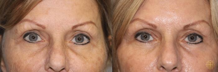 Before & After Blepharoplasty Case 217 View #1 View in Newport Beach, CA
