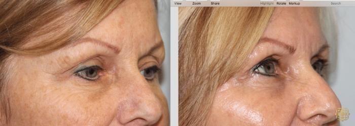 Before & After Blepharoplasty Case 217 View #2 View in Newport Beach, CA