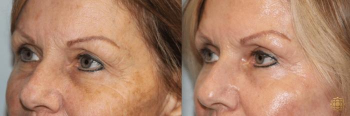 Before & After Blepharoplasty Case 217 View #3 View in Newport Beach, CA