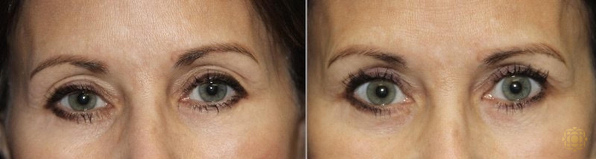 Before & After Blepharoplasty Case 218 View #1 View in Newport Beach, CA