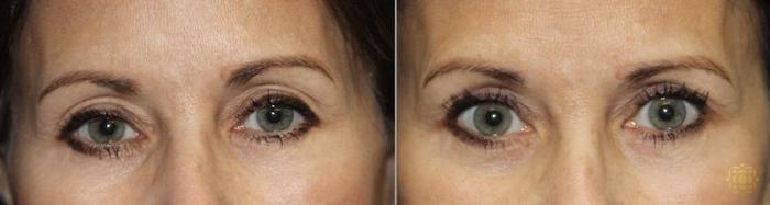 Before & After Blepharoplasty Case 218 View #1 View in Newport Beach, CA
