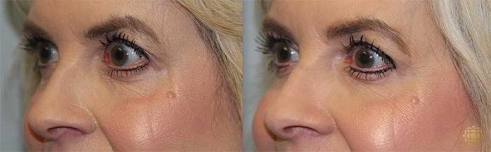 Before & After Blepharoplasty Case 220 Left Oblique View in Newport Beach, CA