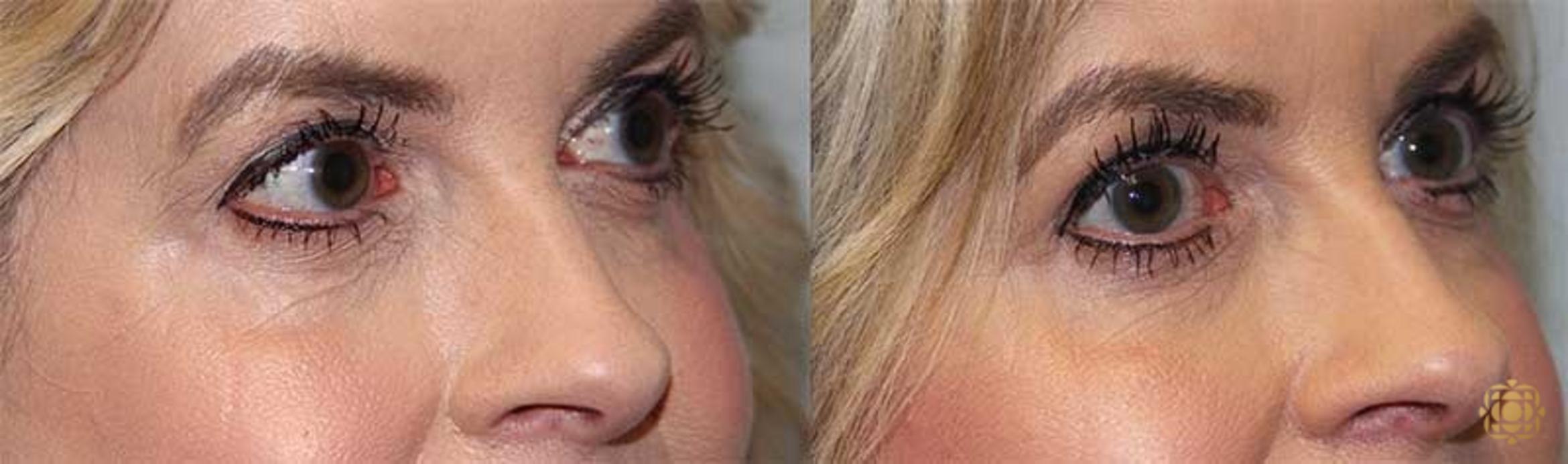 Before & After Blepharoplasty Case 220 Right Oblique View in Newport Beach, CA