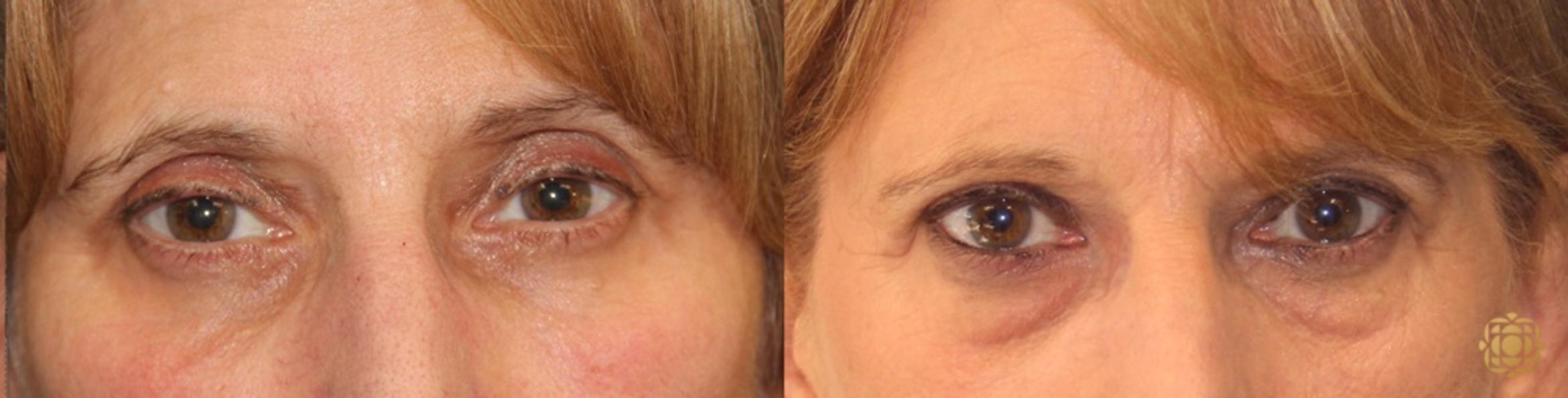 Before & After Blepharoplasty Case 224 View #1 View in Newport Beach, CA