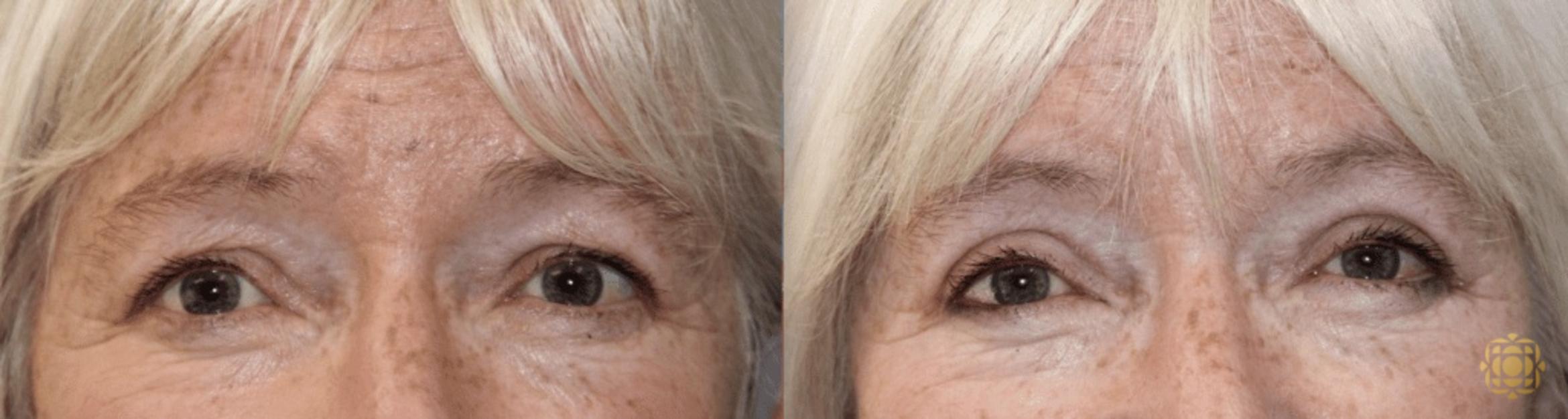 Before & After Blepharoplasty Case 228 Front View in Newport Beach, CA