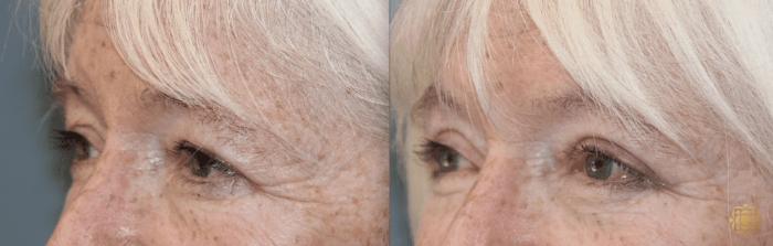 Before & After Blepharoplasty Case 228 Left Oblique View in Newport Beach, CA