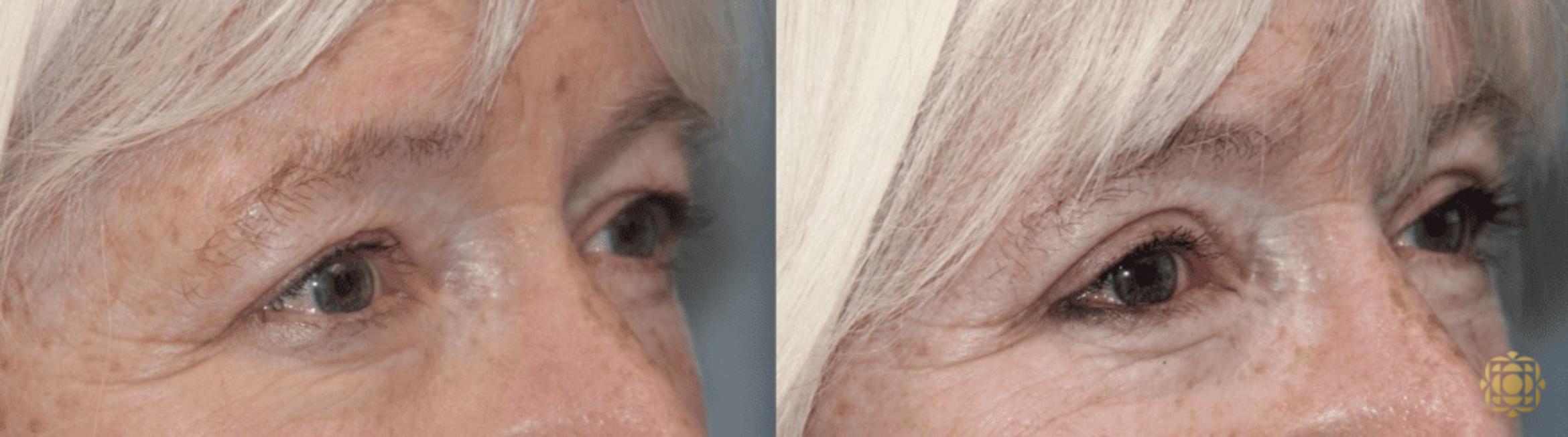Before & After Blepharoplasty Case 228 Right Oblique View in Newport Beach, CA