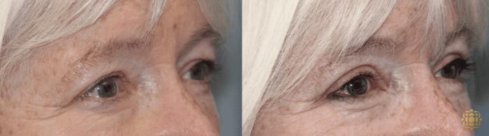 Before & After Blepharoplasty Case 228 Right Oblique View in Newport Beach, CA