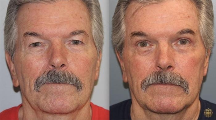 Before & After Blepharoplasty Case 246 Front View in Newport Beach, CA