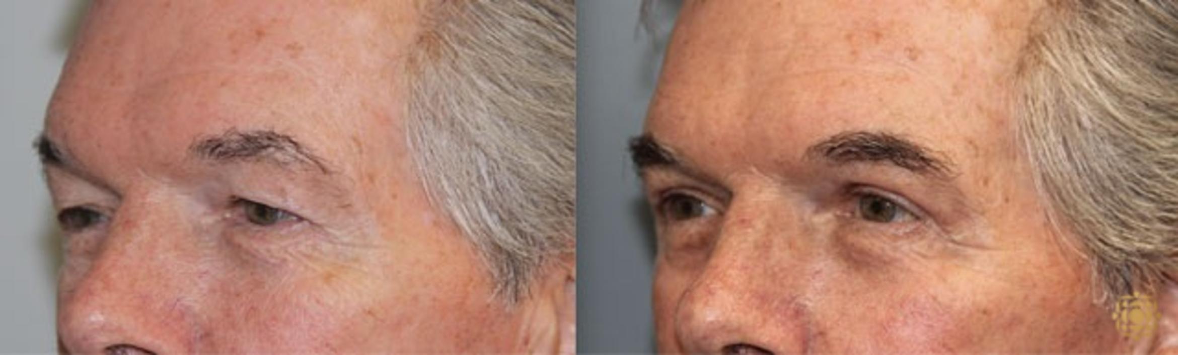 Before & After Blepharoplasty Case 246 Left Oblique View in Newport Beach, CA