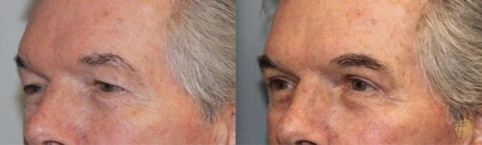 Before & After Blepharoplasty Case 246 Left Oblique View in Newport Beach, CA