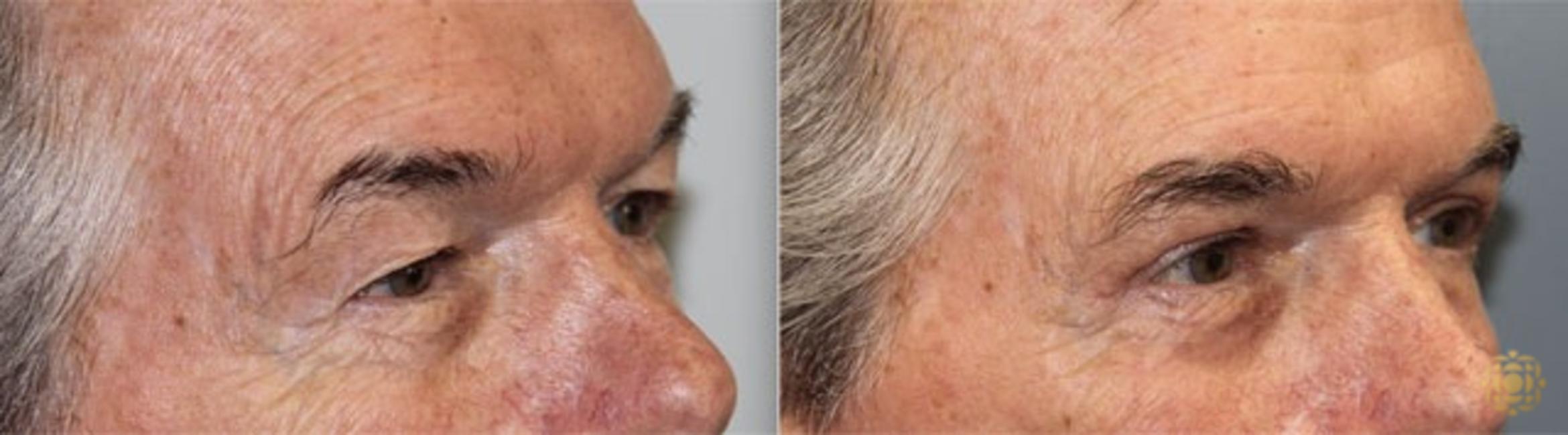Before & After Blepharoplasty Case 246 Right Oblique View in Newport Beach, CA