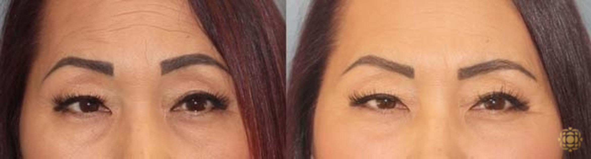 Before & After Blepharoplasty Case 252 Front View in Newport Beach, CA