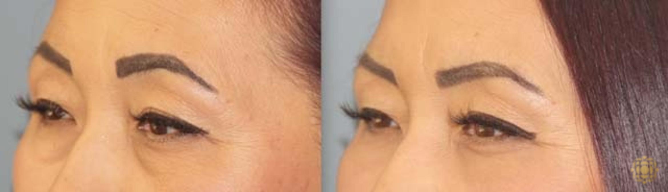 Before & After Blepharoplasty Case 252 Left Oblique View in Newport Beach, CA