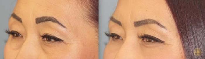Before & After Blepharoplasty Case 252 Left Oblique View in Newport Beach, CA