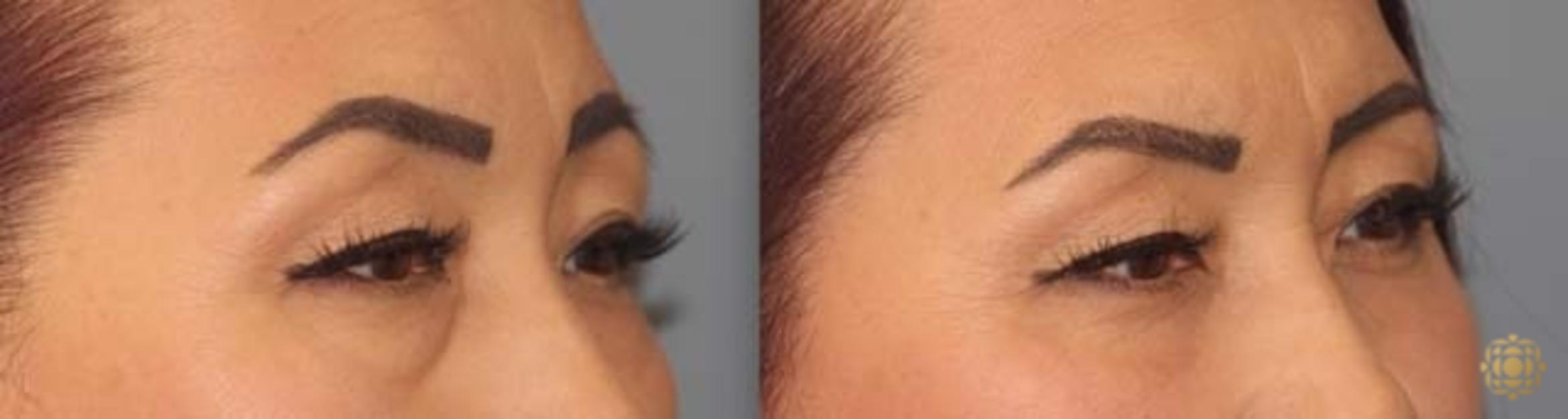 Before & After Blepharoplasty Case 252 Right Oblique View in Newport Beach, CA
