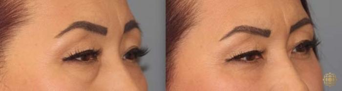 Before & After Blepharoplasty Case 252 Right Oblique View in Newport Beach, CA