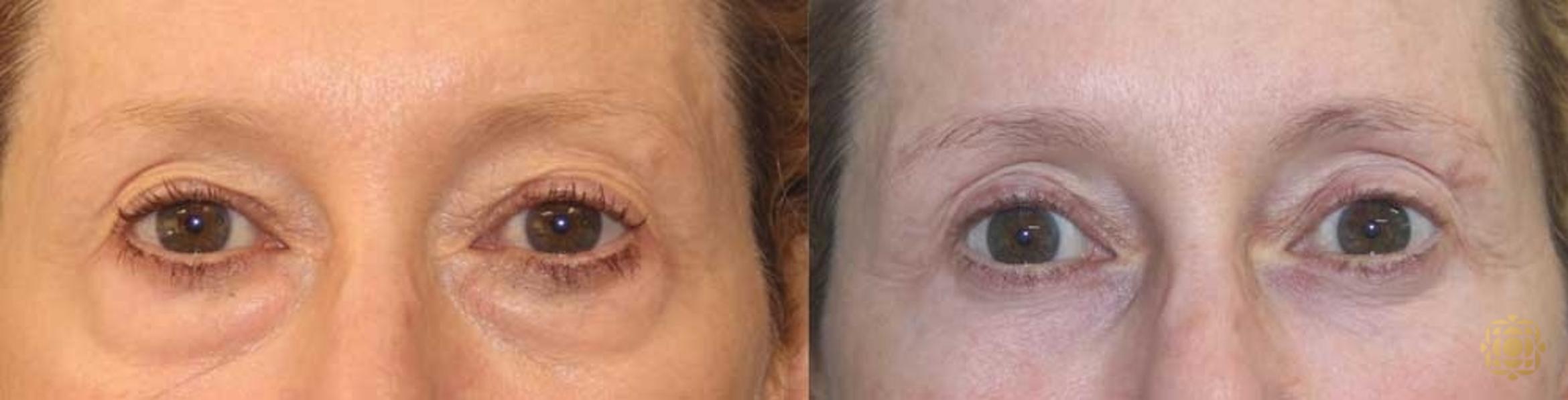 Before & After Blepharoplasty Case 255 Front View in Newport Beach, CA