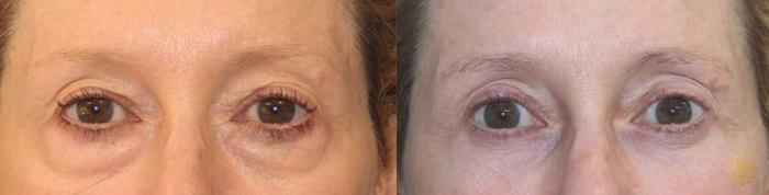 Before & After Blepharoplasty Case 255 Front View in Newport Beach, CA