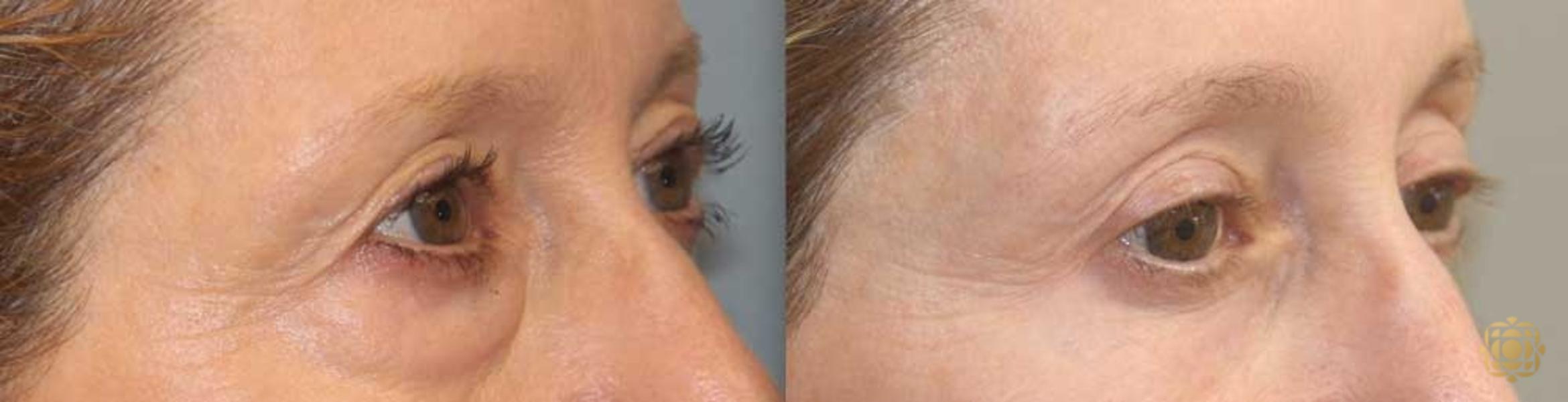 Before & After Blepharoplasty Case 255 Left Oblique View in Newport Beach, CA