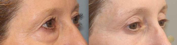 Before & After Blepharoplasty Case 255 Left Oblique View in Newport Beach, CA
