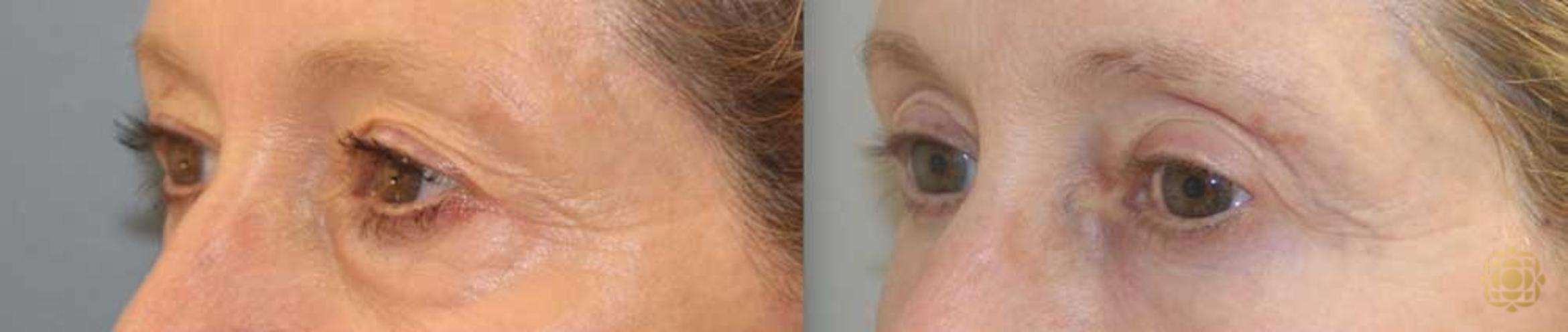 Before & After Blepharoplasty Case 255 Right Oblique View in Newport Beach, CA