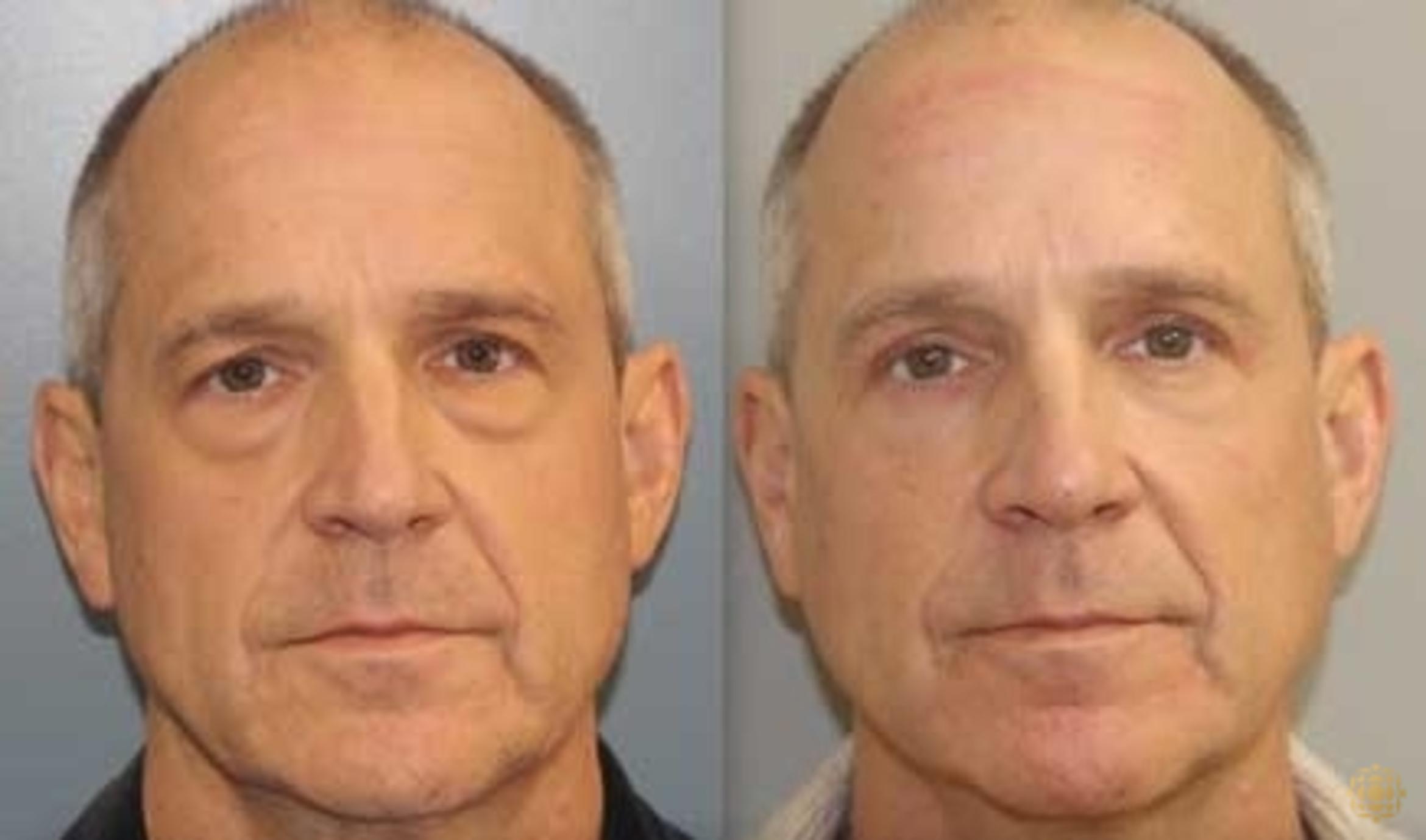 Before & After Blepharoplasty Case 260 Front View in Newport Beach, CA