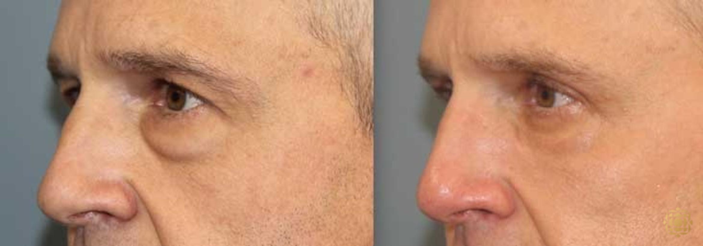 Before & After Blepharoplasty Case 260 Left Oblique View in Newport Beach, CA