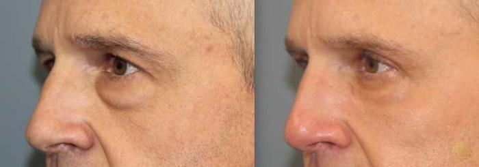 Before & After Blepharoplasty Case 260 Left Oblique View in Newport Beach, CA