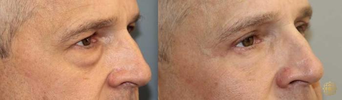 Before & After Blepharoplasty Case 260 Right Oblique View in Newport Beach, CA