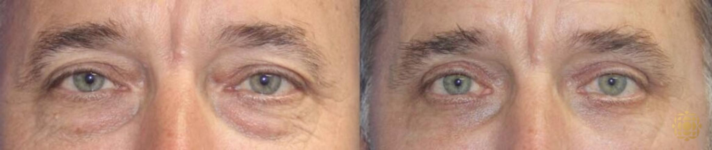 Before & After Blepharoplasty Case 261 View #1 View in Newport Beach, CA