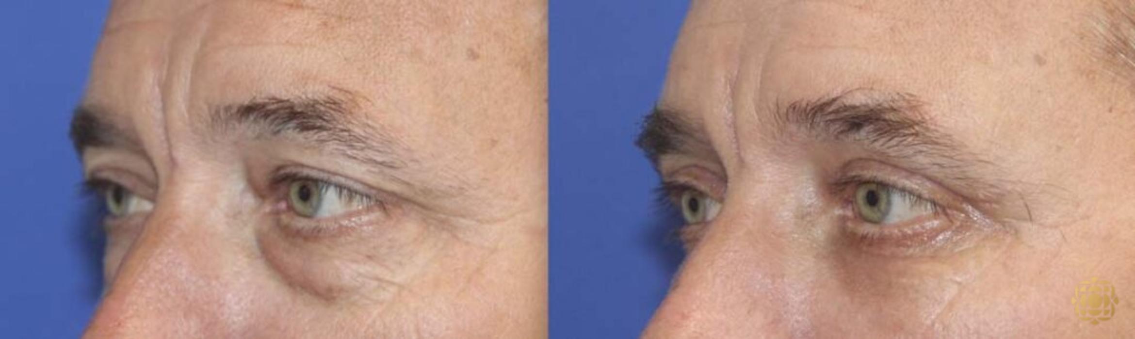 Before & After Blepharoplasty Case 261 View #2 View in Newport Beach, CA