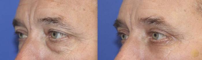 Before & After Blepharoplasty Case 261 View #2 View in Newport Beach, CA
